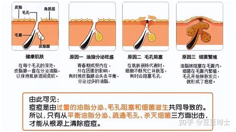 山根長痘|山根长痘痘是什么原因